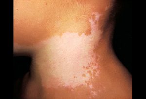 original_vitiligo-neck