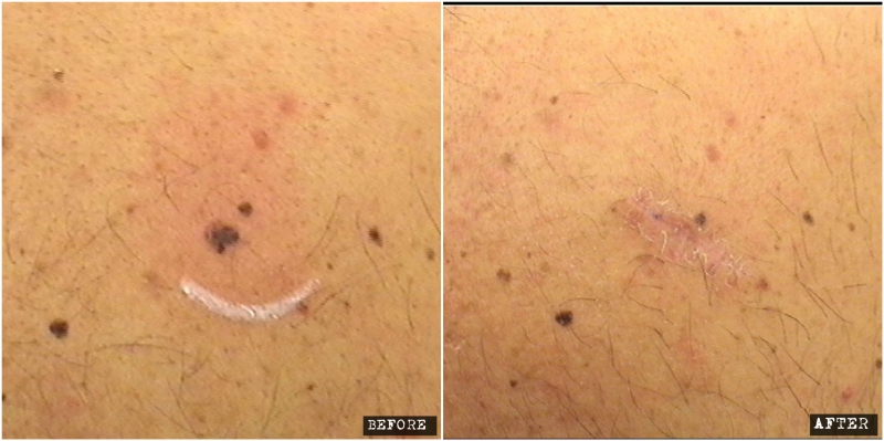 Dysplastic mole surgical removal