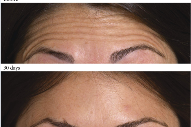 Ρυτίδες έκφρασης στην περιοχή του μετώπου, πρίν και μετά τη θεραπεία με Botox.
